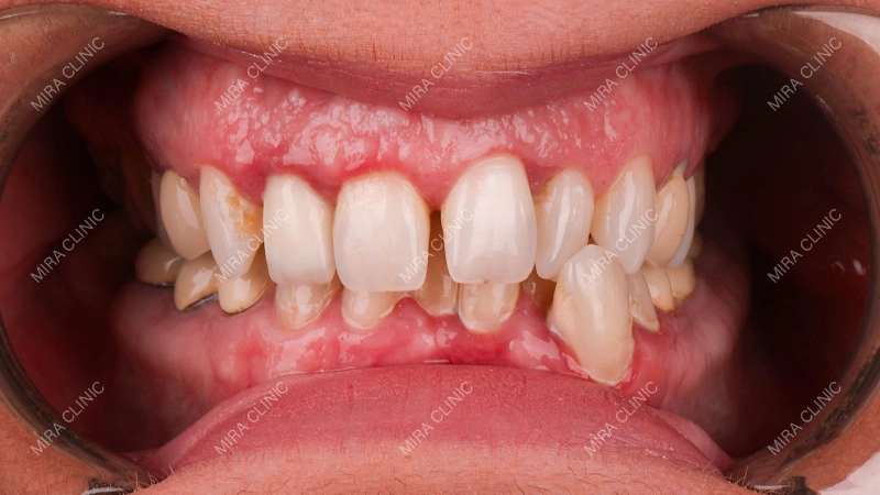 dental alignment issue